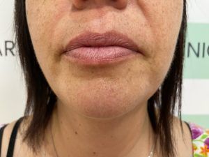 hyaluron pen tratamiento facial antes