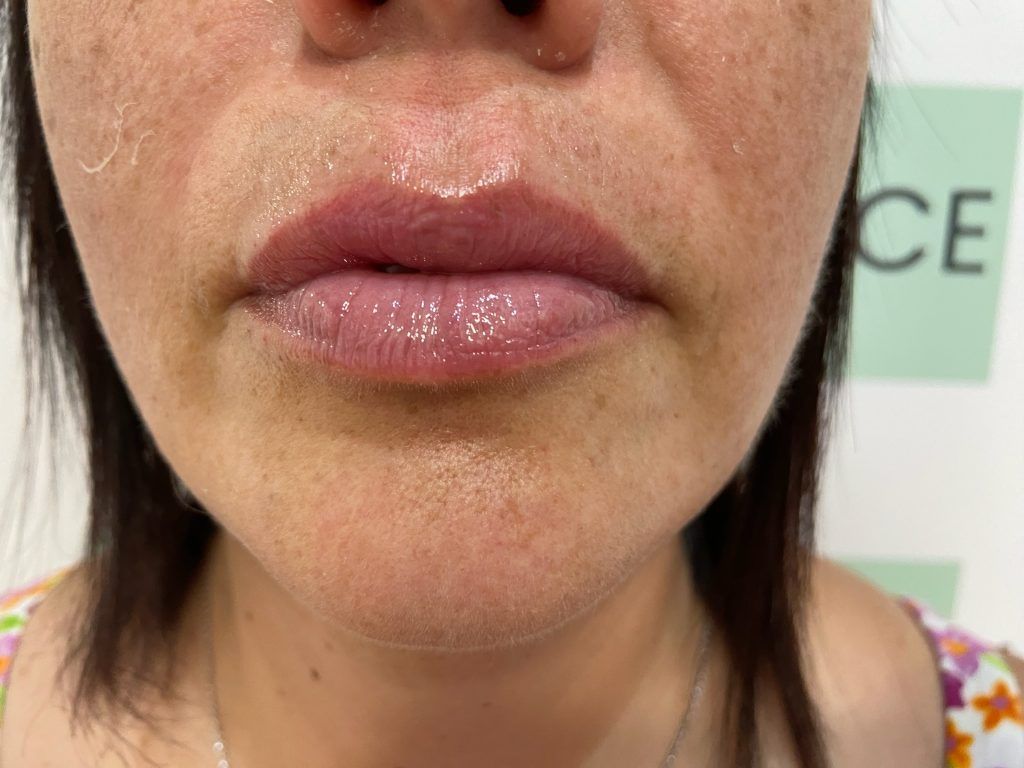 hyaluron pen tratamiento labios fuenlabrada