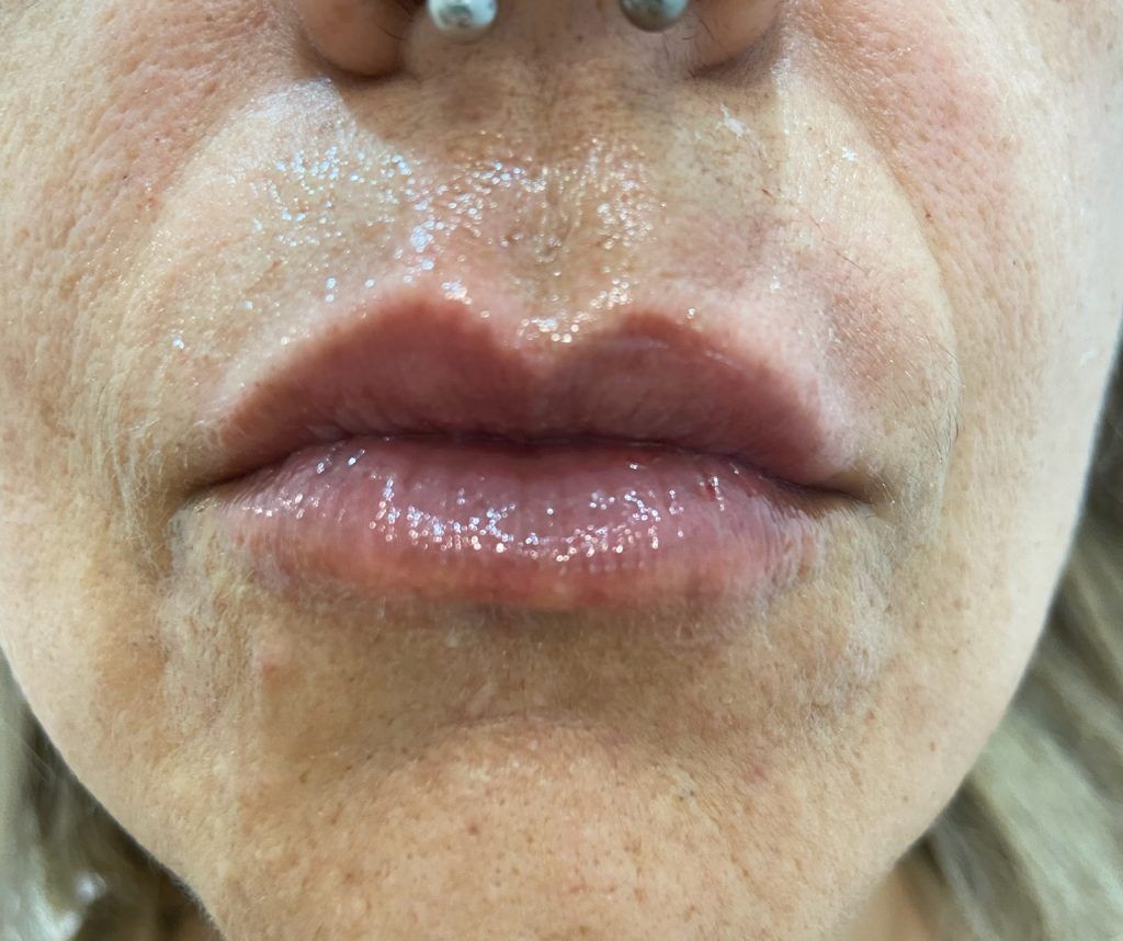 tratamiento facial labios hyaluron pen