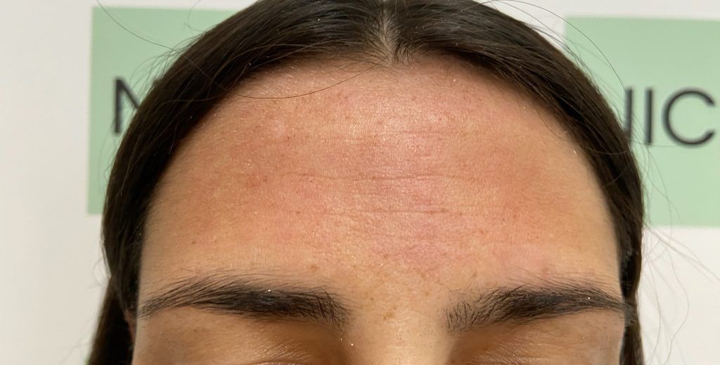 cara tratamiento facial hyaluron pen